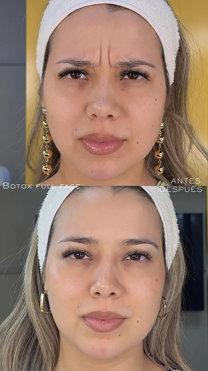 Resultado Toxina Botulínica — frontal