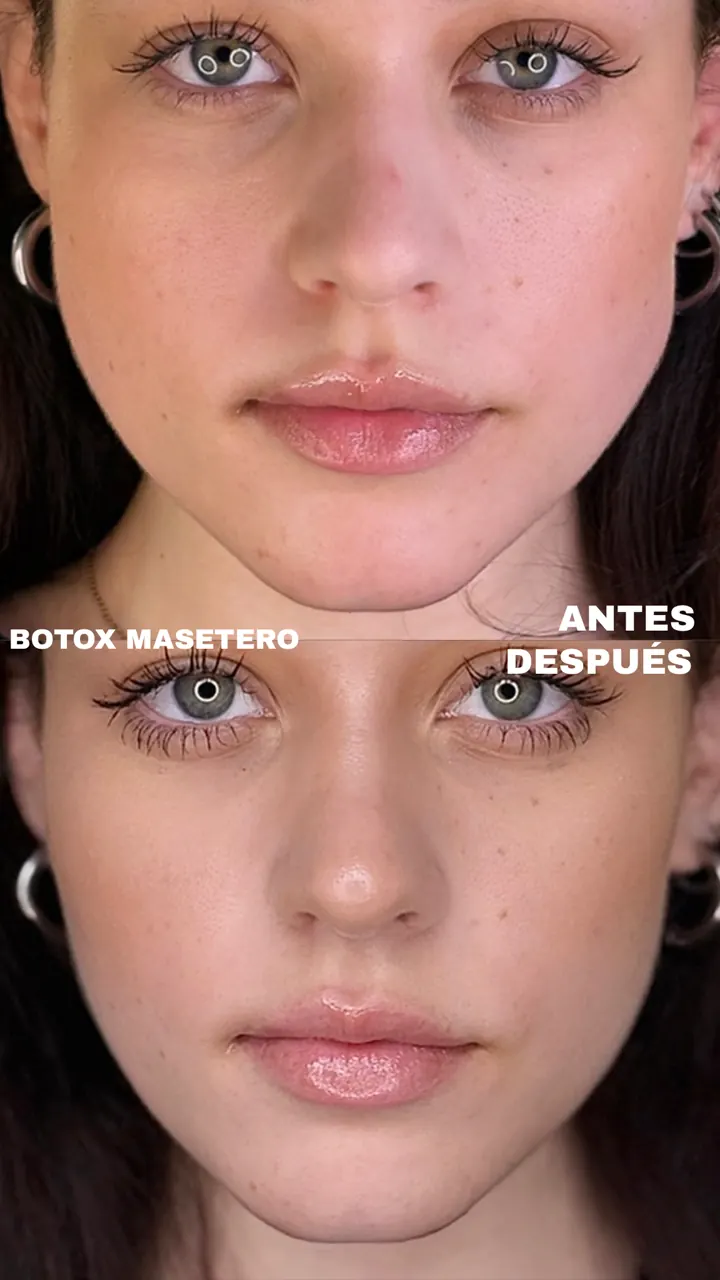 Antes y después — Botox Masetero (Frontal)