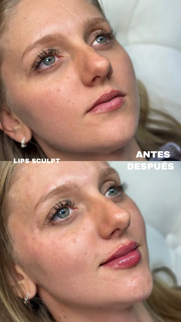 Resultado Lipsculpt — labios