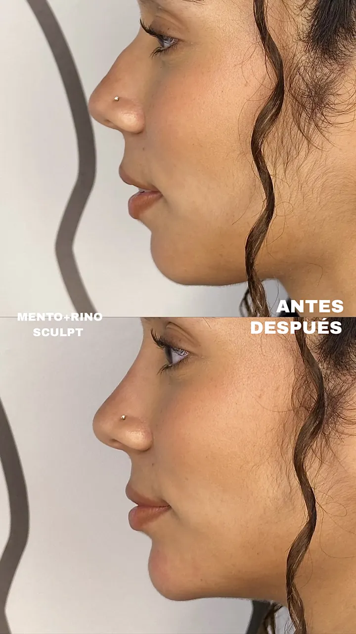 Antes y después — Mento + Rinosculpt (Perfil)