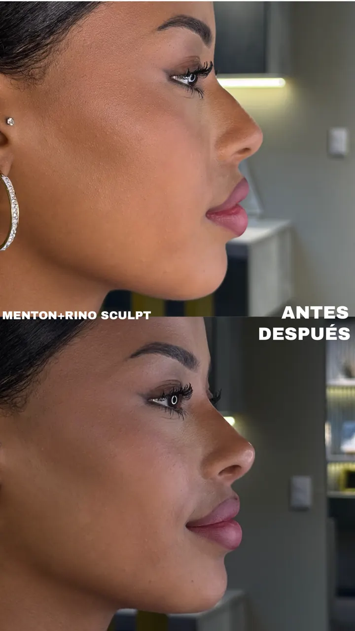 Antes y después — Mentón + Rinosculpt (Perfil)