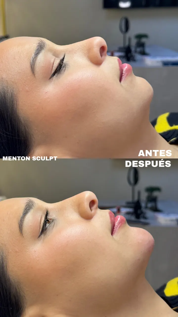 Antes y después — Mentón Sculpt (Perfil)