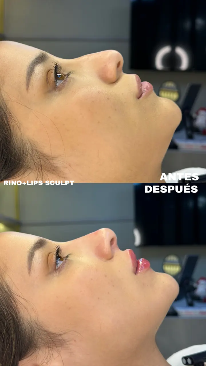 Antes y después — Rinosculpt + Lipsculpt (Perfil)