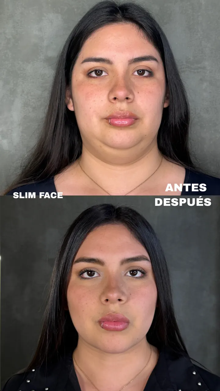 Antes y después — Slim Face (Frontal)