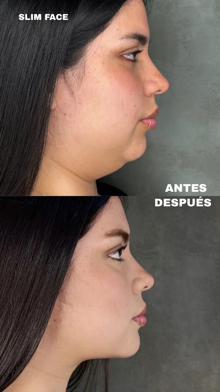 Antes y después — Slim Face (Perfil)